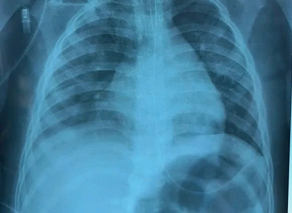 Sau mắc sởi, bé gái đông đặc phổi do cúm A