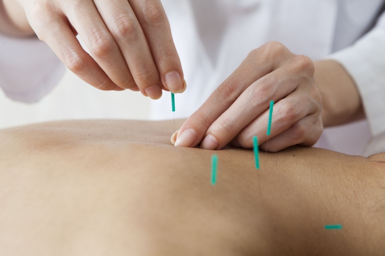 Cấy chỉ huyệt đạo điều trị được nhiều bệnh nan y, mãn tính