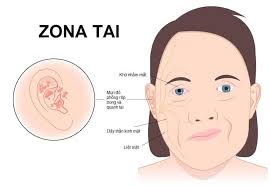 Liệt mặt, ù tai do zona thần kinh