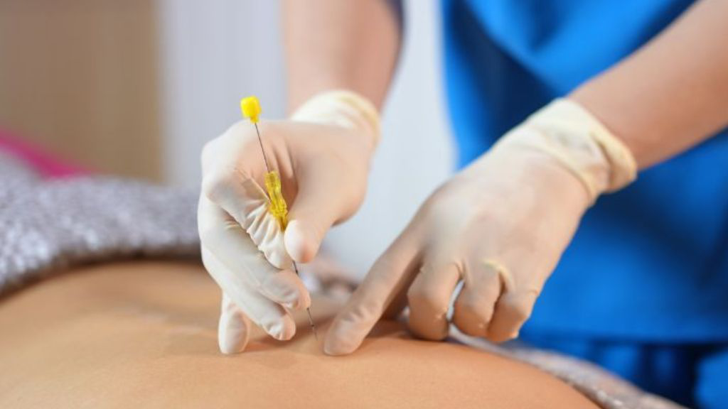 Cấy chỉ trong y học cổ truyền