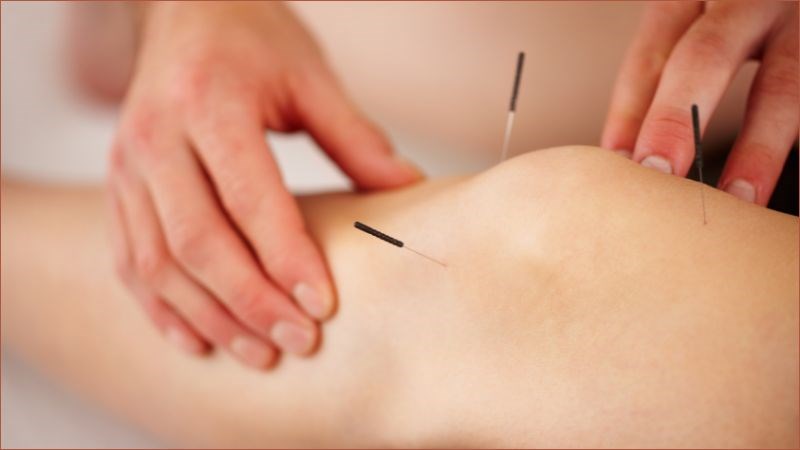 CẤY CHỈ GIẢM MỠ, GIẢM BÉO