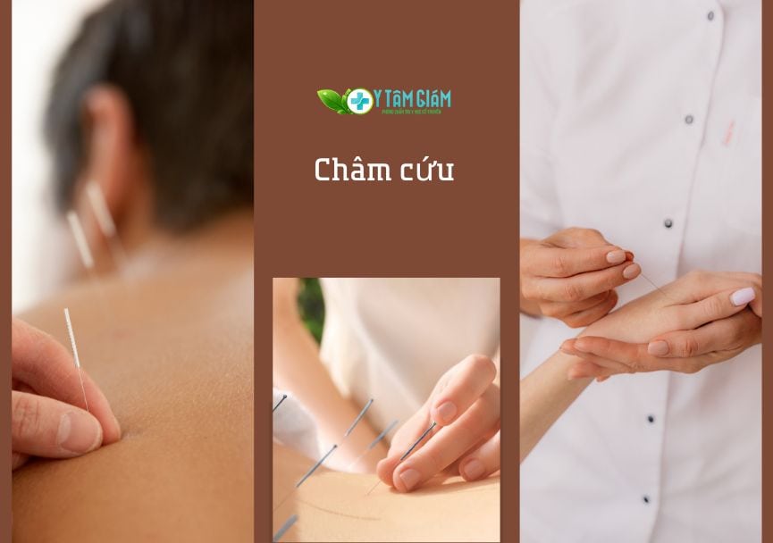 CHÂM CỨU TRONG Y HỌC CỔ TRUYỀN