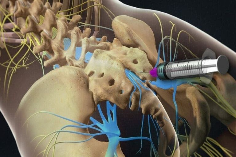 Thủy châm điều trị đau thần kinh tọa