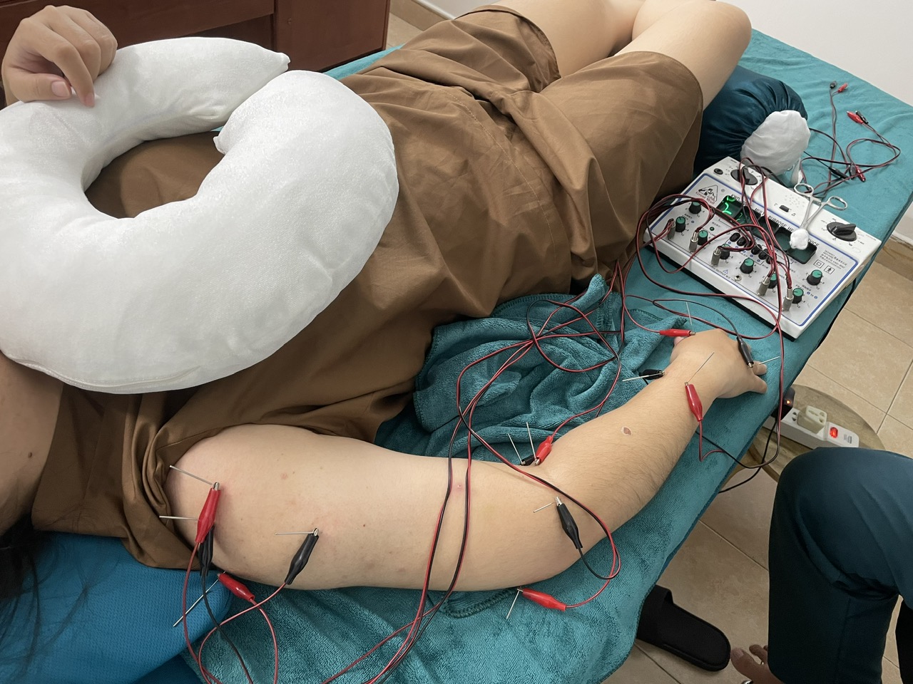 Điều trị bệnh Tennis elbow (hay còn gọi là hội chứng khuỷu tay tennis)
